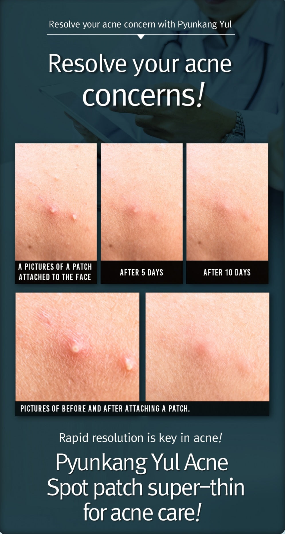 Pyunkang yul Acne Spot Patch Super Thin (15EA)
